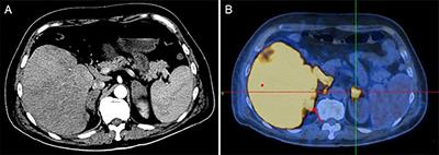 Case Report: Intravascular Large B-Cell Lymphoma: A Clinicopathologic Study of Four Cases With Review of Additional 331 Cases in the Literature